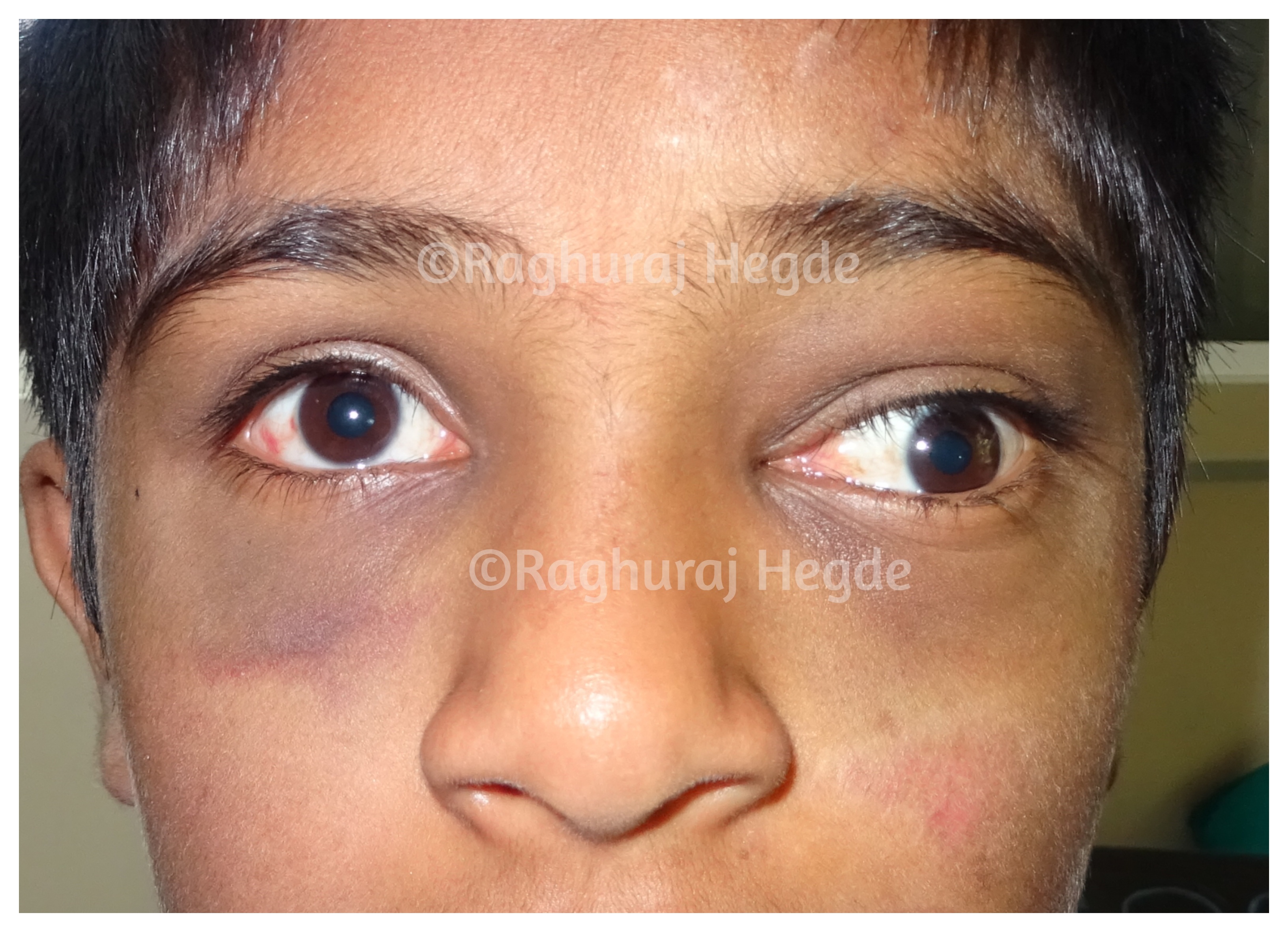 Emergency Radiology Saves An Eye!